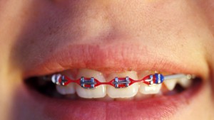 braces_1505421973662_10903703_ver1.0